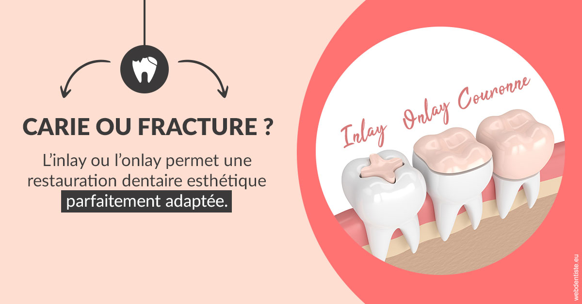 https://selarl-dr-philippe-schweizer.chirurgiens-dentistes.fr/T2 2023 - Carie ou fracture 2