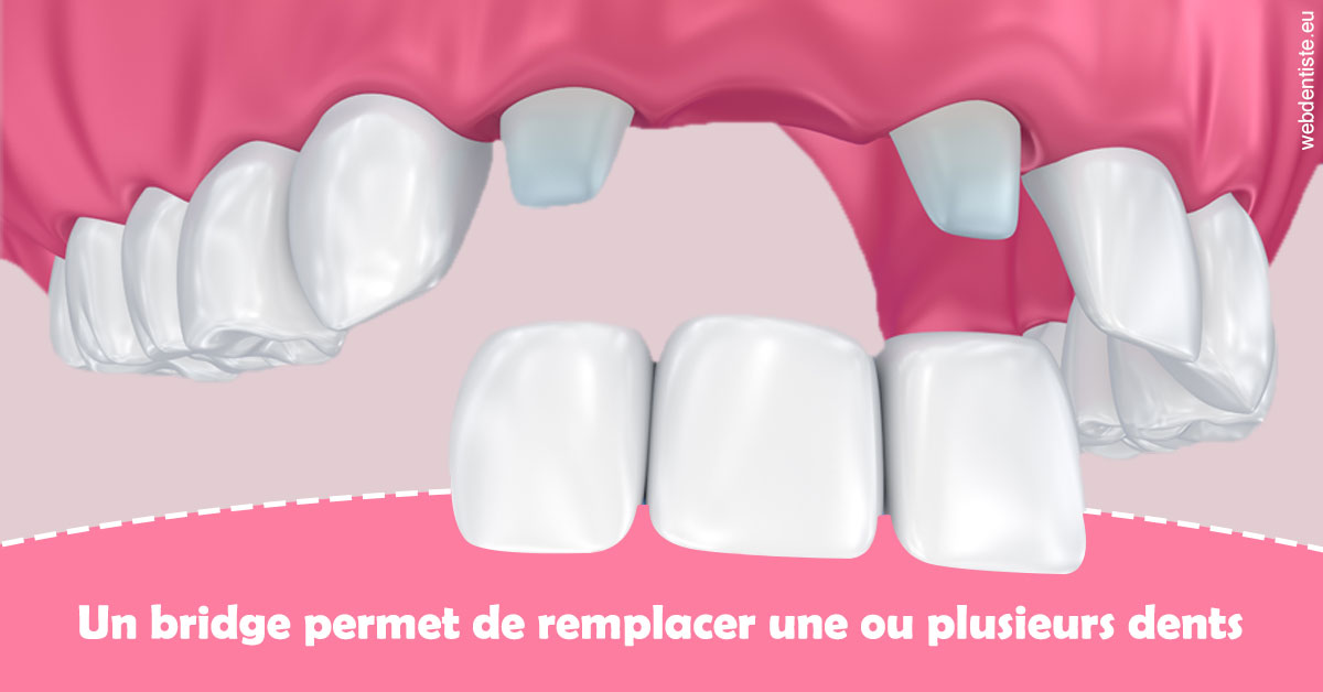 https://selarl-dr-philippe-schweizer.chirurgiens-dentistes.fr/Bridge remplacer dents 2