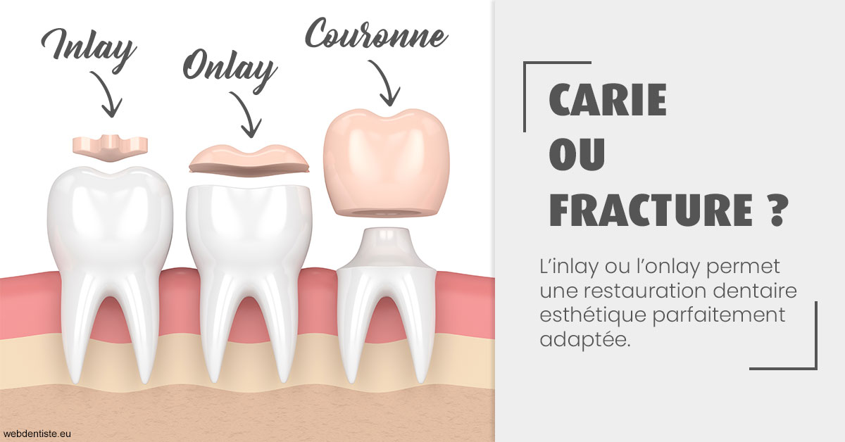 https://selarl-dr-philippe-schweizer.chirurgiens-dentistes.fr/T2 2023 - Carie ou fracture 1