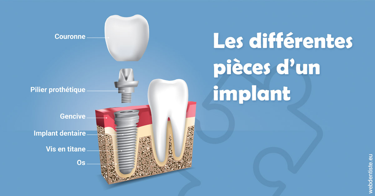 https://selarl-dr-philippe-schweizer.chirurgiens-dentistes.fr/Les différentes pièces d’un implant 1